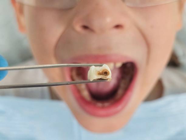 Best Emergency Dental Care for Broken or Chipped Teeth in Columbia, SC