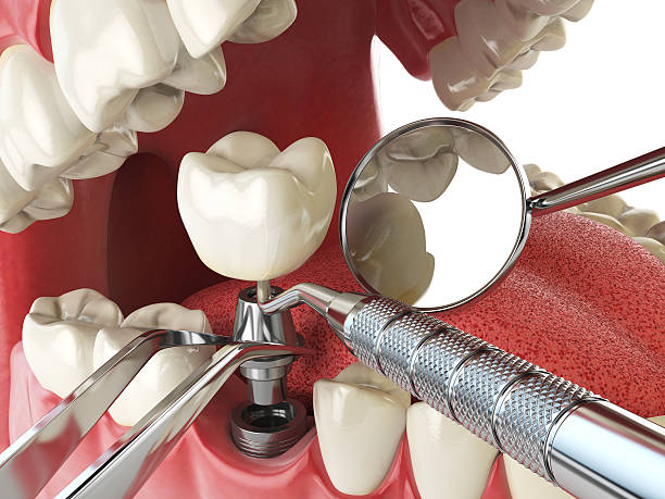 Best Emergency Wisdom Teeth Removal in Columbia, SC