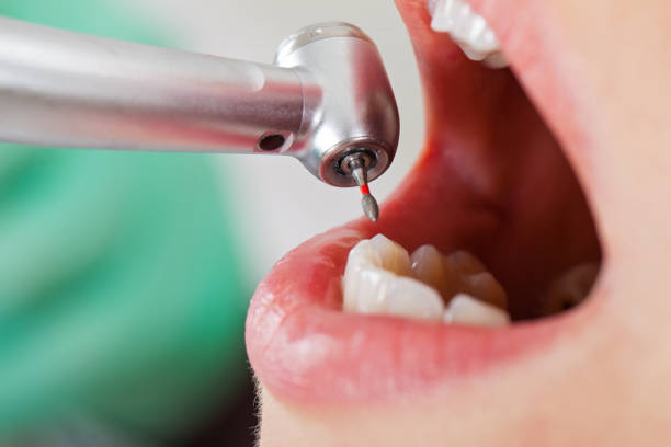 Best Emergency Tooth Extraction in Columbia, SC